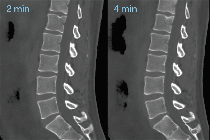 BoneMRI introduces new features for faster scanning and enhanced imaging
